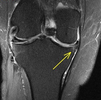 Figure 3 for case chondrocalcinosis within chronic unstable medial meniscus flap tear and adjacent tibial remodeling ( RID5398 )